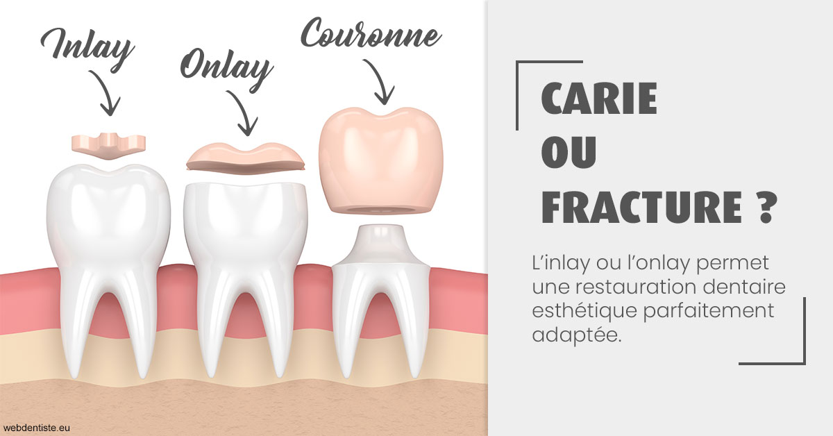 https://dr-paul-graindorge.chirurgiens-dentistes.fr/T2 2023 - Carie ou fracture 1