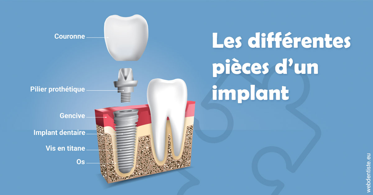 https://dr-paul-graindorge.chirurgiens-dentistes.fr/Les différentes pièces d’un implant 1