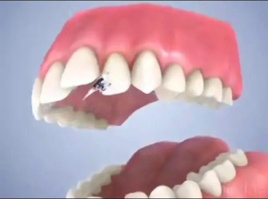Orthodontie Linguale 3D